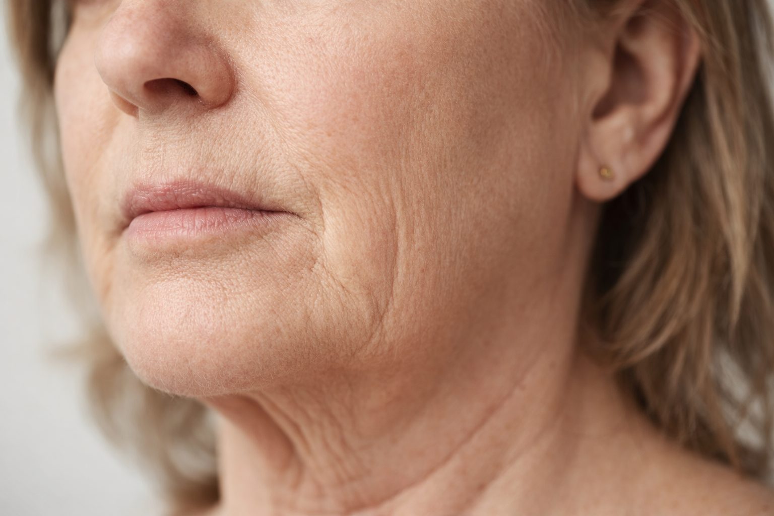 Relâchement du bas du visage, du cou et des bajoues avant traitement par fils tenseurs à la clinique Le Centre au Québec | Lower face, neck and jowl laxity before thread lift treatment at Le Centre clinic in Quebec