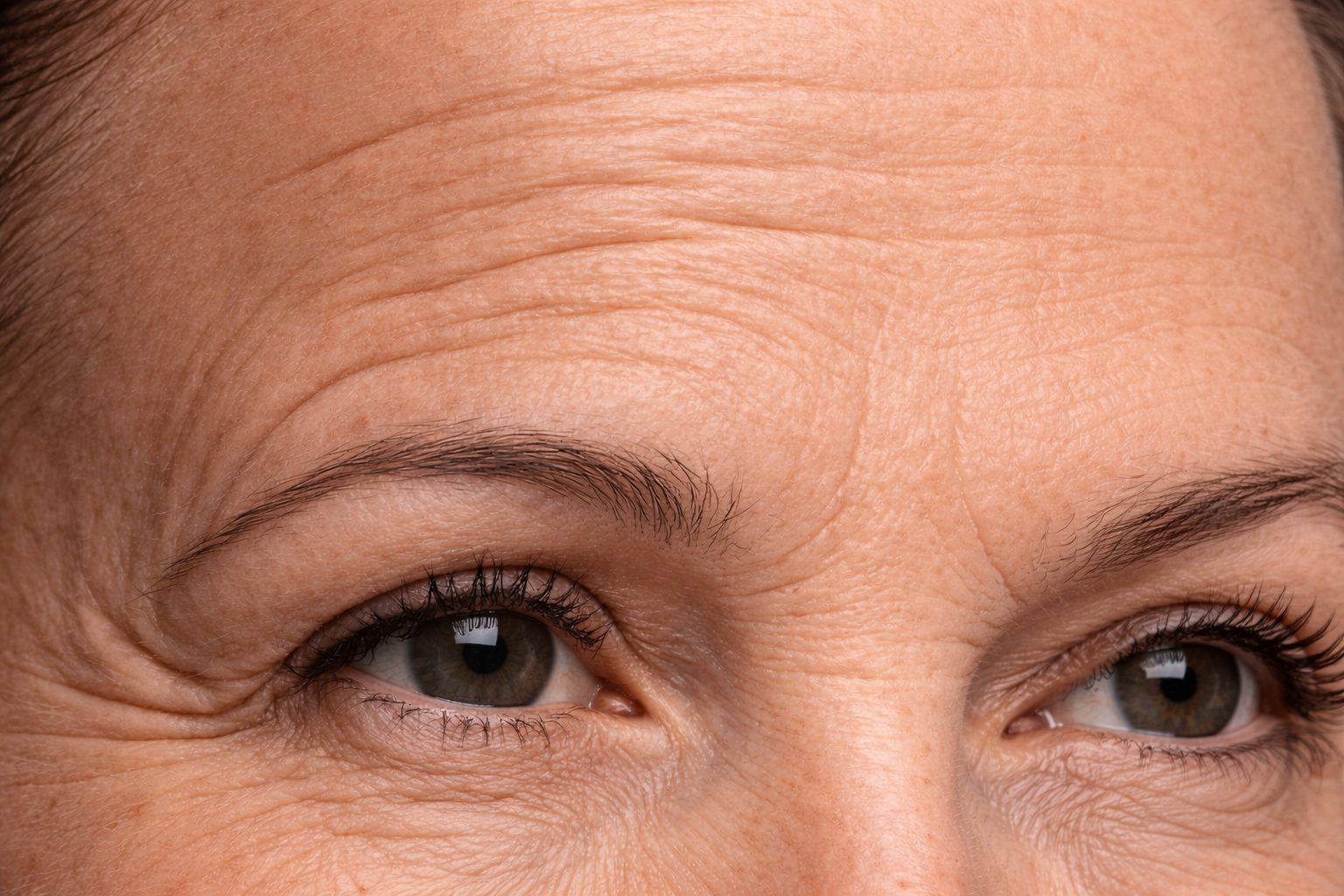 Rides du front et pattes d'oie avant traitement par injection de neuromodulateurs à la clinique Le Centre au Québec | Forehead lines and crow's feet before neuromodulator injection treatment at Le Centre clinic in Quebec