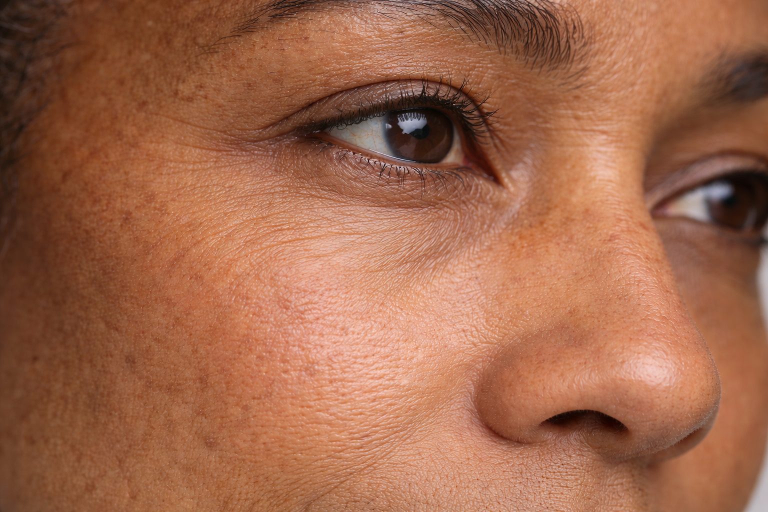 Peau du contour des yeux avant traitement par plasma riche en plaquettes PRP à la clinique Le Centre au Québec | Under-eye skin before platelet-rich plasma PRP treatment at Le Centre clinic in Quebec